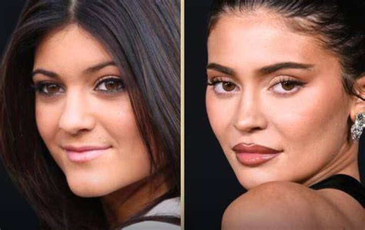 Kylie Jenner Lip Fillers Plastic Surgery Before and After Photos